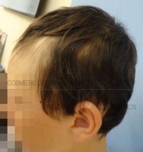 alopeki1