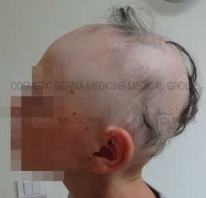 alopeki2