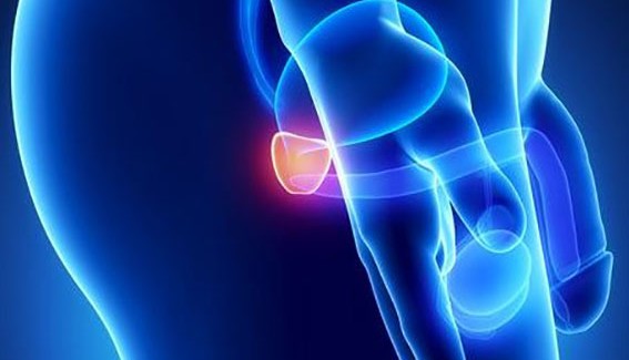 ΓΙΑ ΤΟΝ ΚΑΡΚΙΝΟ ΤΟΥ ΠΡΟΣΤΑΤΗ