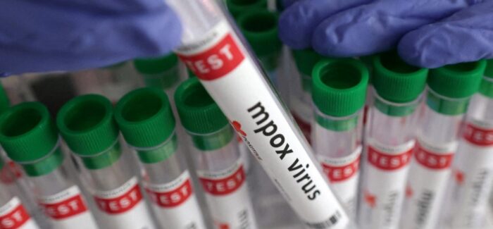Mpox: Συναγερμός στον ΕΟΔΥ: Καταγράφηκαν 18 επιβεβαιωμένα κρούσματα